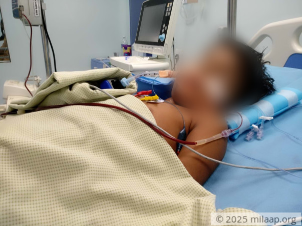 5-year-old Nivetha is fighting to stay alive after a Pneumonia attack