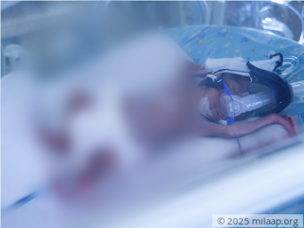 Only 600 Grams At Birth, These Twins Need Help To Survive