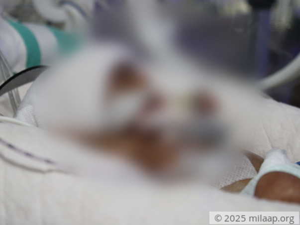 Palm-sized Preemie Fights To Stay Alive While Parents Plead For Help