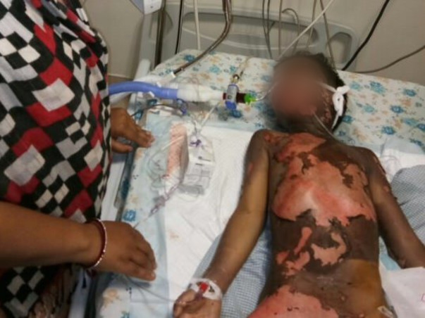6 Year old kid Moiz Burnt Grievously in contact with high tension wire