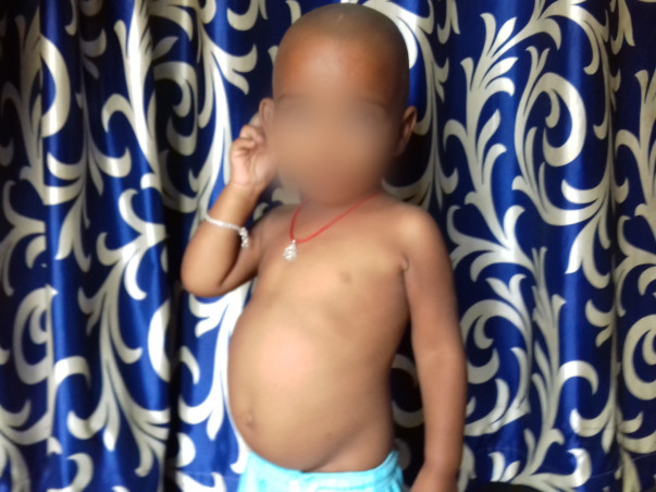 Help 2-year-old Akhilesh undergo a liver transplant
