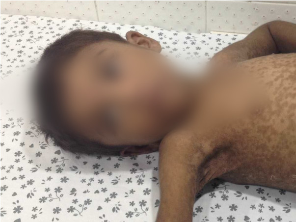 Help This 5-year-old With A Liver Abscess Who Is Screaming In Pain