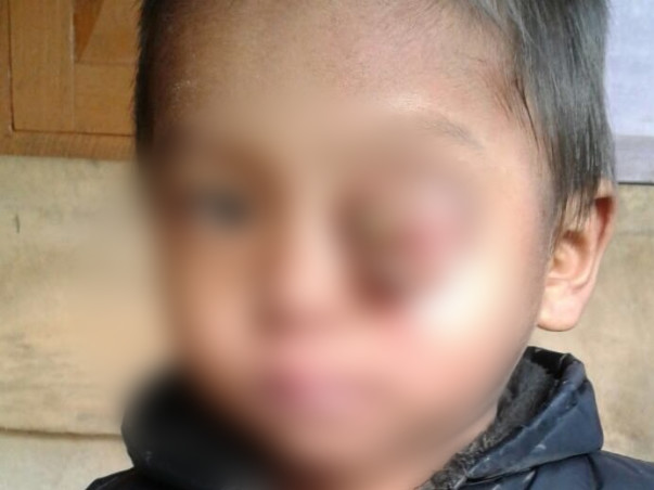 Baby Keffrien's Eye Has Been Ravaged By Cancer, Save His Life
