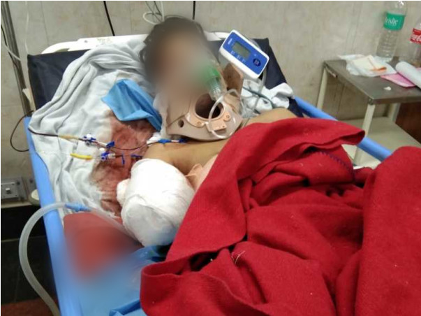 Class-9 Boy Lost His Hands And Leg After A Train Ran Over Him