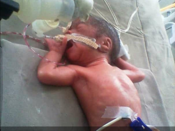 Help this girl to live life after getting birth in premature period