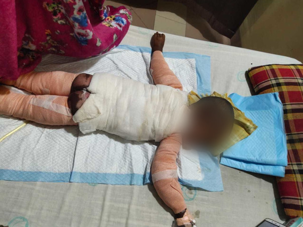 Help Bhanu Shiva Prasad To Fight His Body Burns