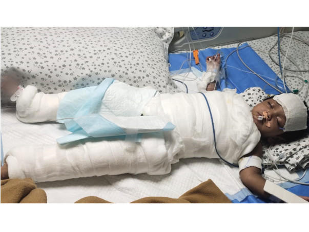 Support Anaya Mehiwish  Recover From Burn Injury 80 %