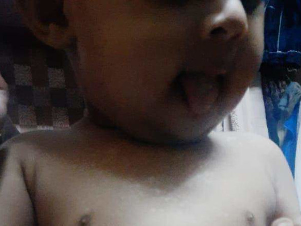 3 Years Old Zainab Fatima Needs Your Help Fighting Skin Cancer
