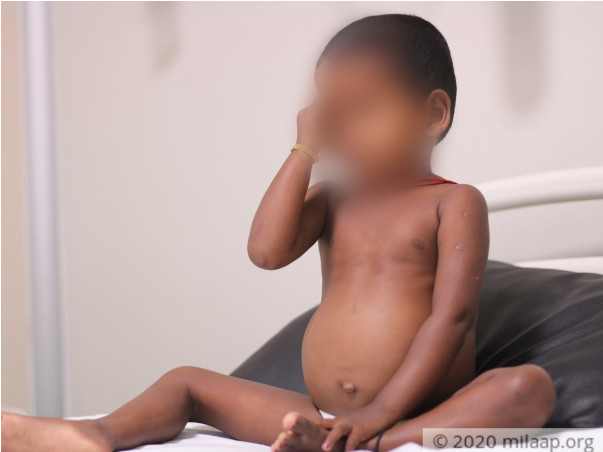 A Rare Genetic Disease Is Breaking This 3-Year-Old’s Bones
