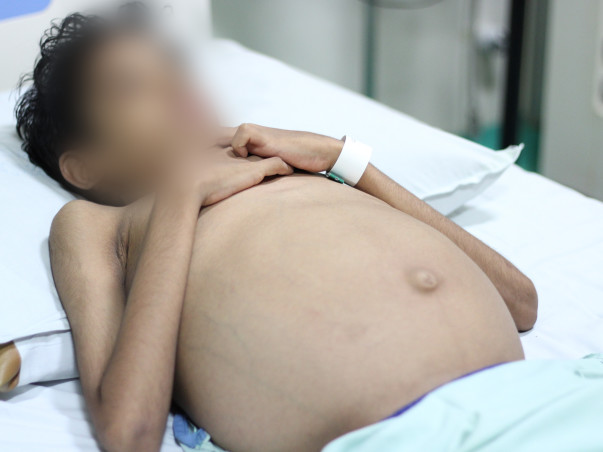A Dangerous Liver Disease Has Reduced This Teenager To Just Bones