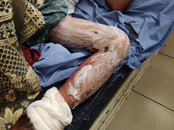 Support Sameer Recover From Electricity Burn