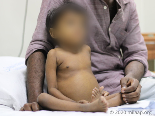 3-Year-Old’s Stomach Is Swollen Like A Football, She Needs Help