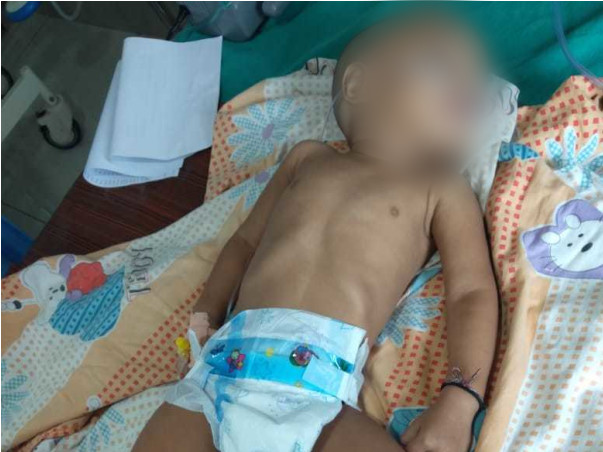 11 months old Lakshmi Chetan needs your help fight Head injury