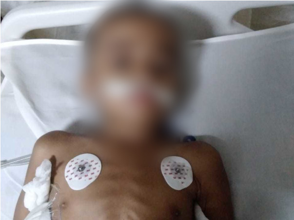 4 Years Old Gowardhan Needs Your Help Fight Langerhans Cell Histiocytosis (LCH)