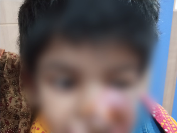 This 4 Years Old Needs Your Urgent Support In Recovering Paranasal Sinus And Nasal Cavity Cancer