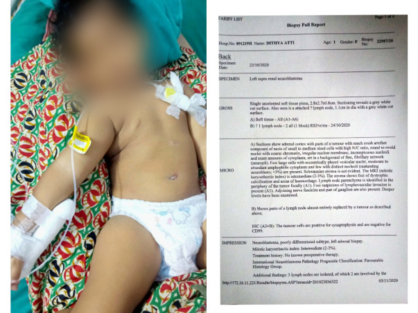 Support Dithya Atti Recover From Neuroblastoma Cancer