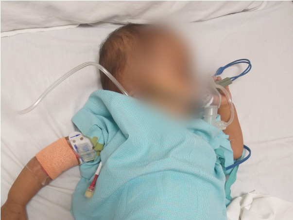 Baby Ananya needs your help to fight JMML with nf1 blood cancer