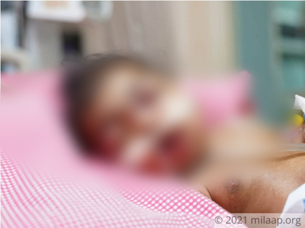 6 months old Charanya needs your help fight Severe dengue with HLH