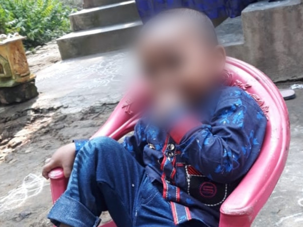4 Years Old Rohith Needs Your Help Fight Deep Scald Burns