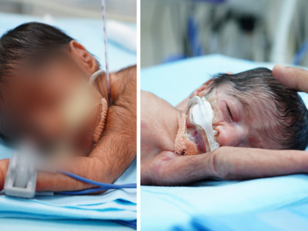 Support Babies Of Akhila  To Recover From  Preterm Birth