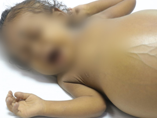 1-Year-Old With Watermelon-Sized Stomach Needs Urgent Liver Transplant