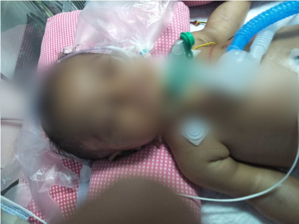 Help My Son To Recover From Lungs Infection And Spinal Muscular Atrophy (SMA)