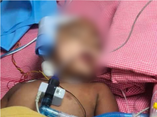 Support 3 Year Old Nitesh To Recover From Multi Organ Dys Syndrome