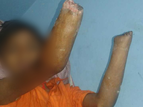 14 Years Old Pintu Paswan Needs Your Help To Recover From Accident