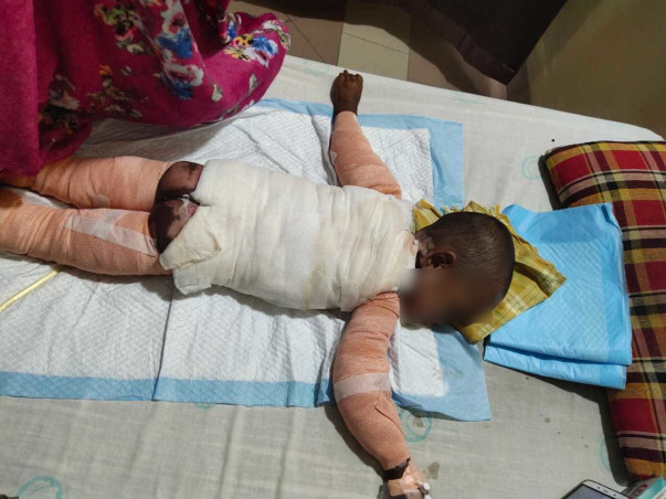 Help Bhanu Shiva Prasad To Fight His Body Burns