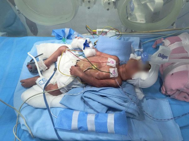 Help Save Premature Twin Baby Girls of Sneha & Dheeraj