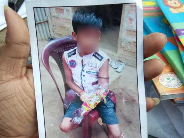 Help 7 Years Old Ramdas  To Undergo Plastic Surgery
