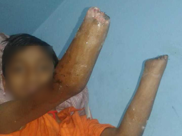 14 Years Old Pintu Paswan Needs Your Help To Recover From Accident