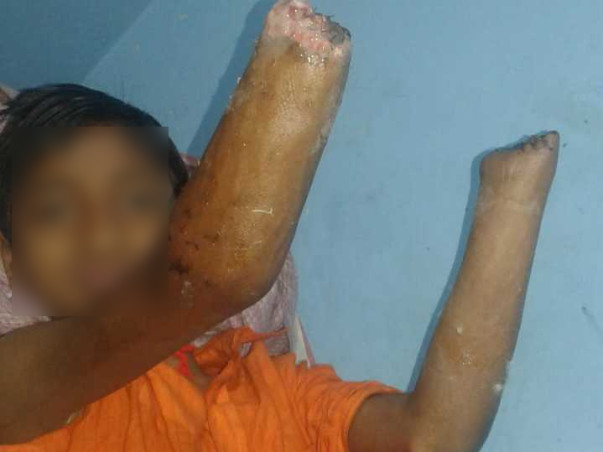 14 Years Old Pintu Paswan Needs Your Help To Recover From Accident