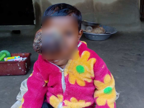 Help Ashik Recover From Retinoblastoma