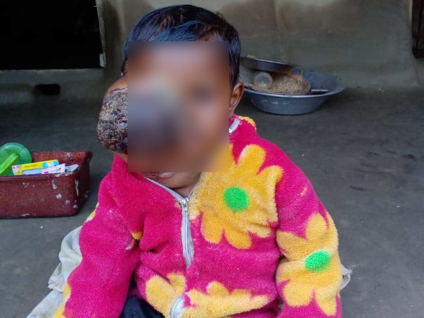 Help Ashik Recover From Retinoblastoma