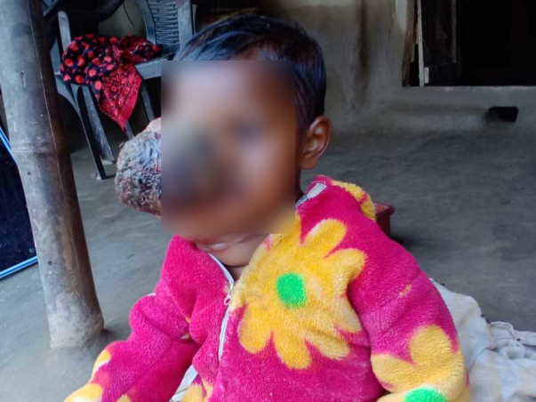 Help Ashik Recover From Retinoblastoma