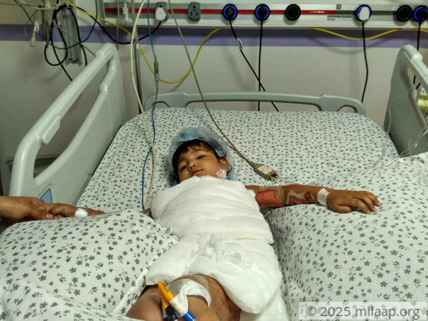 2-Year Old Is In The ICU After Falling Into A Bucket Of Boiling Water