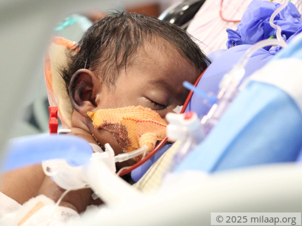 Despite Working Hard, Daily Wager Can't Save Baby From Heart Disease