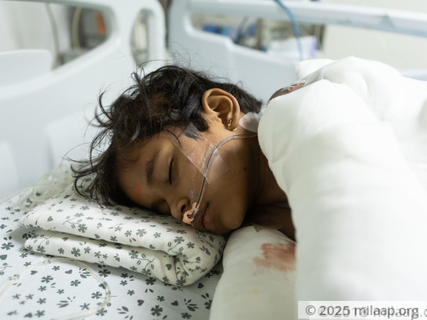 This Girl's Whole Body Got Burnt While Bursting Crackers, Needs Help