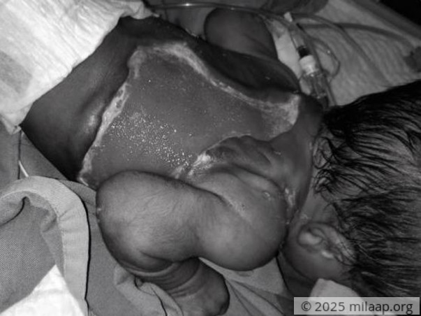 Flesh-Eating Bacteria Took Away Nearly Half The Skin Off Baby's Back