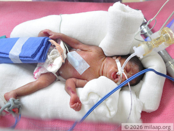 Help Akshaya and Mayur save their prematurely born twins