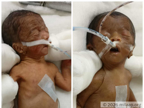 Help Sujata and Pravin save ther prematurely born babies