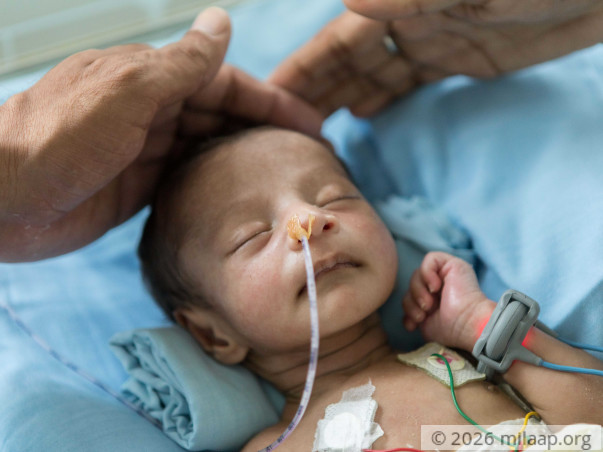 Baby Born With A Hole In His Stomach Is Fighting To Survive