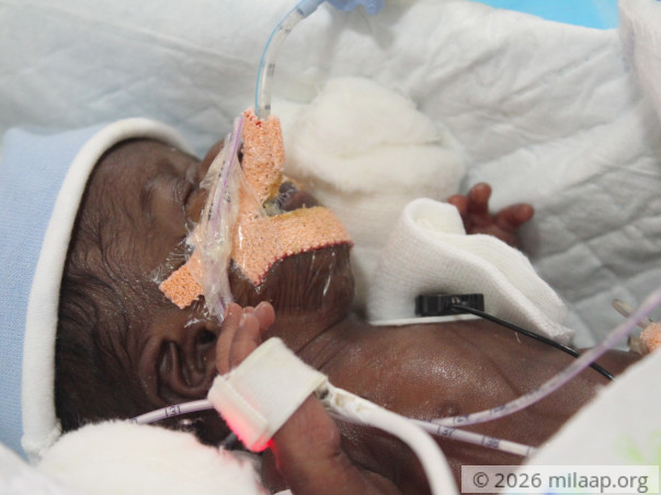 Nurse's 20-day-old Baby Is Now Bleeding Into His Lungs And Needs Help