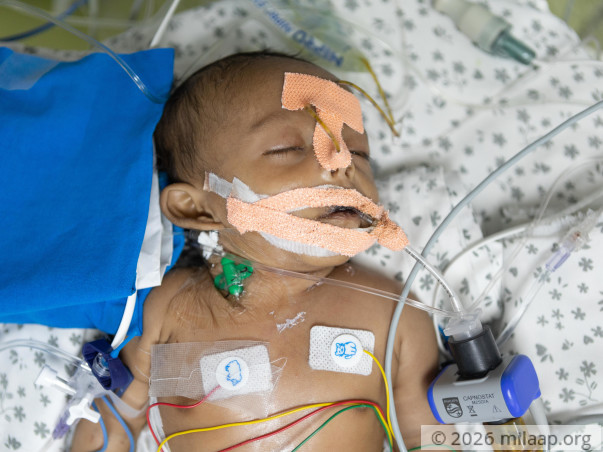 Savita's Newborn May Need A 3rd Surgery If He Cannot Get PICU Care