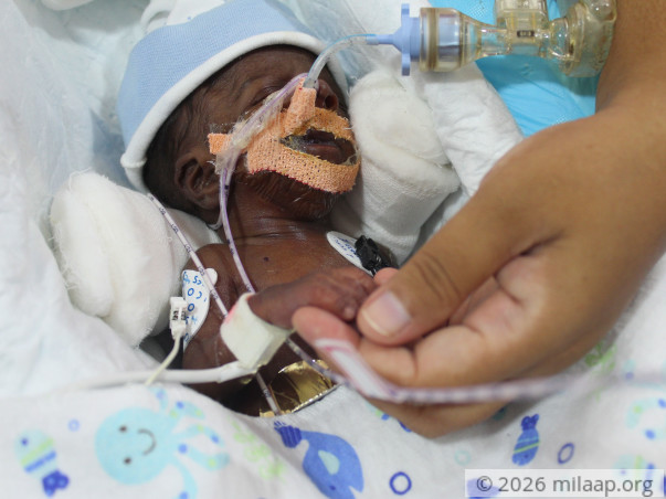 Nurse's 20-day-old Baby Is Now Bleeding Into His Lungs And Needs Help