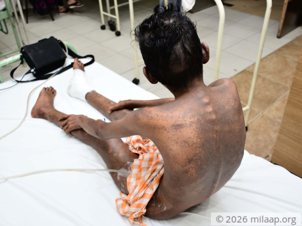 14-year-old with painful boils all over body needs urgent transplant