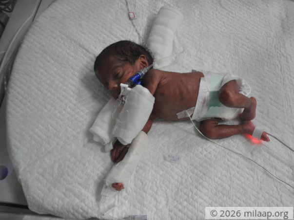 Extremely Premature Twins Fighting Multiple Illnesses Need Urgent Help