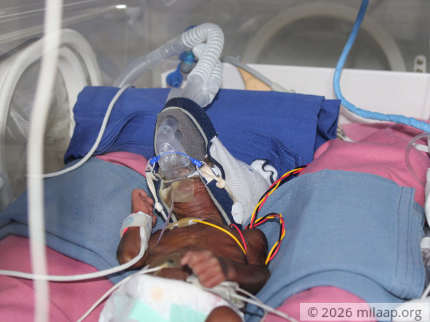 Mother Struggles To Save Only Surviving Baby of Her Triplets