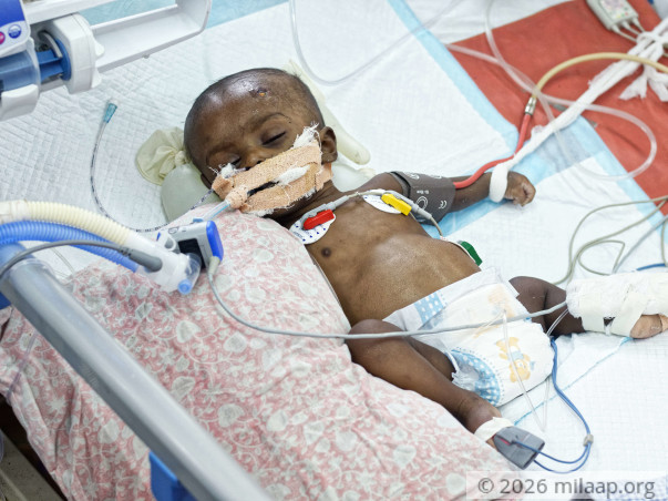 Despite Being On Ventilator, This Baby Boy Will Die Without Help Now